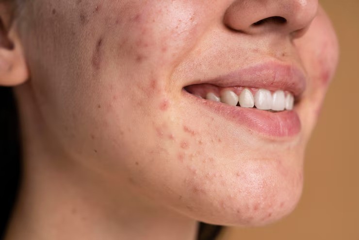 kecantikan dari dalam, usus sehat untuk kulit cerah, hubungan pencernaan dan kulit, cara alami atasi jerawat, tips kulit sehat alami, manfaat probiotik untuk kulit, perawatan kulit dari dalam, cara menjaga pencernaan ibu muda.